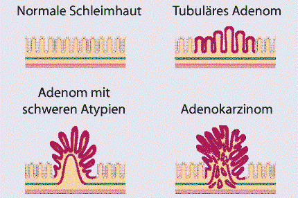 Darmkrebs